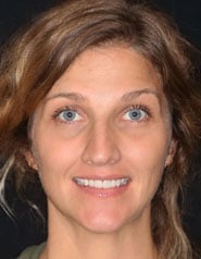 Before Image: Case 295 - front