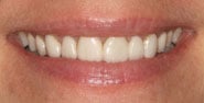 Before Image: Case 295 - front