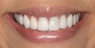 After Image: Case 296 - front