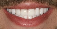 After Image: Case 297 - front