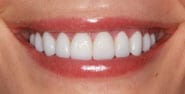 After Image: Case 298 - front