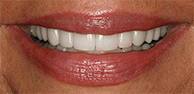 After Image: Case 30 - front