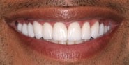 After Image: Case 300 - front