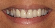 Before Image: Case 301 - front