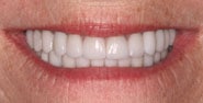 After Image: Case 302 - front
