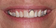Before Image: Case 304 - front
