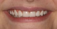 After Image: Case 305 - front