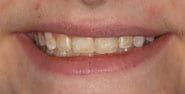 Before Image: Case 305 - front