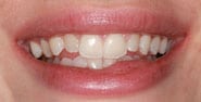 Before Image: Case 306 - front