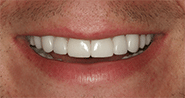 After Image: Case 31 - front
