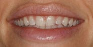 Before Image: Case 310 - front
