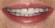 Before Image: Case 311 - front