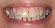 Before Image: Case 312 - front