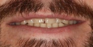 Before Image: Case 313 - front