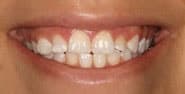 Before Image: Case 314 - front