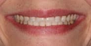 Before Image: Case 315 - front