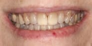 Before Image: Case 316 - front