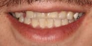 Before Image: Case 317 - front