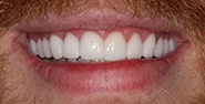 After Image: Case 318 - front