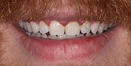 Before Image: Case 318 - front