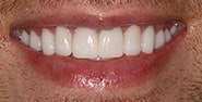 After Image: Case 319 - front