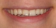 Before Image: Case 319 - front