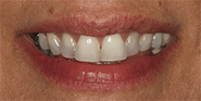 Before Image: Case 32 - front