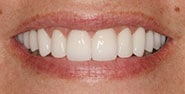 After Image: Case 320 - front