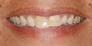 Before Image: Case 320 - front