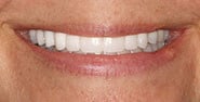 After Image: Case 321 - front