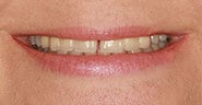 Before Image: Case 321 - front