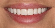 After Image: Case 322 - front