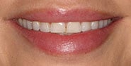 Before Image: Case 322 - front