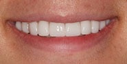 After Image: Case 323 - front