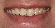 Before Image: Case 323 - front