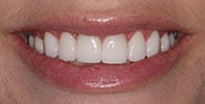 After Image: Case 324 - front