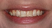 Before Image: Case 324 - front
