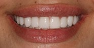 After Image: Case 325 - front