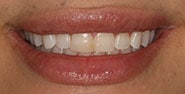 Before Image: Case 325 - front