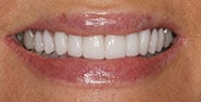 After Image: Case 326 - front