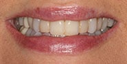 Before Image: Case 326 - front