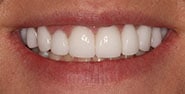 After Image: Case 327 - front