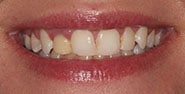 Before Image: Case 327 - front