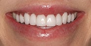 After Image: Case 329 - front