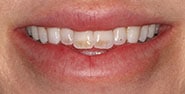 Before Image: Case 329 - front