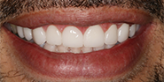 After Image: Case 33 - front