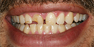 Before Image: Case 33 - front