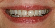 Before Image: Case 330 - front