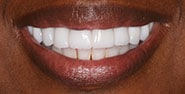 After Image: Case 331 - front