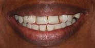Before Image: Case 331 - front